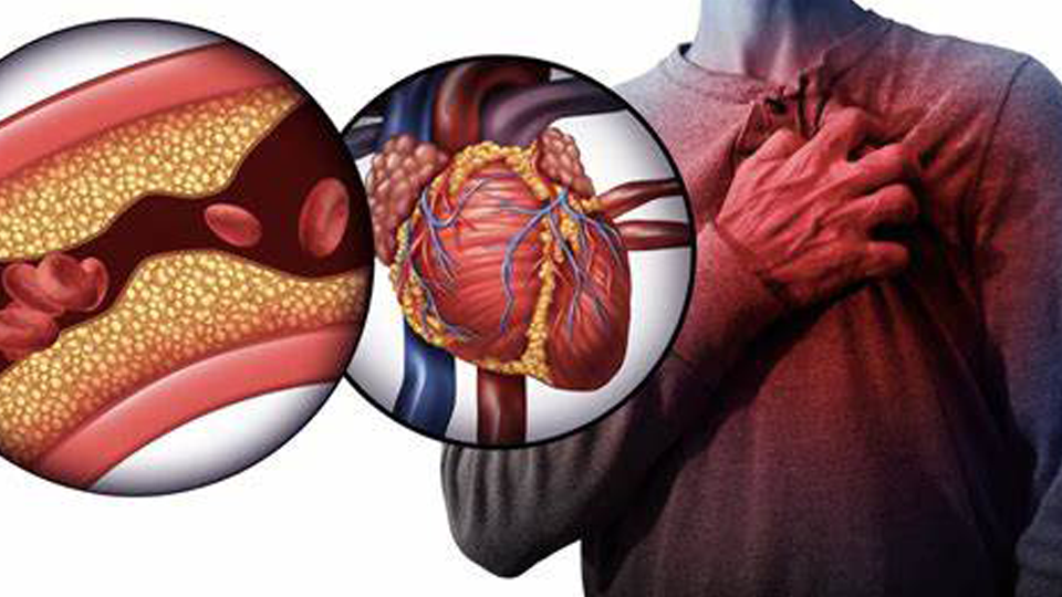 ¿Cuál es la mejor manera de tratar las arterias obstruidas en el corazón? | Grupo i2